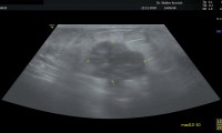 22.12.20. 60 jährige Patientin spürt Knoten in der rechten Brust. Im Brustultraschall hoch verdächtige, großer Tumor 28.2x19.1mm. Nach präoperativer Chemo OP 7.7.21 guter Verlauf.