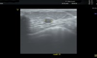 57 jährige Patientin,6mm proteingefülltes Cystchen 6mm,gutartig