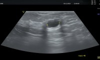 Pat. 45a, bekannte fibro-cystische Mastopathie seit Jahren. Nun neu aufgetretene Cyste, keine Therapie notwendig
