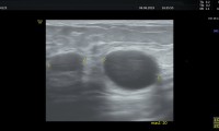 Pat. 51a, seit 4 Jahren bekannte Cyste, keine Therapie