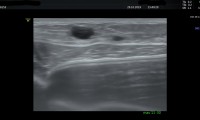 Pat, 35a, beschwerdefrei, 2015 Implantate, gutartige cyste