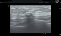 Pat. 60a, beschwerdefrei, seit 14 Jahren bekanntes gutartiges, zum Teil verkalktes, Fibroadenom
