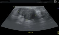 Pat. 29a, seit 10 Jahren sogenannte juvenile Fibroadenomatose,insgesamt bds insgesamt 10 benigen imponierende Fibroadenome DM bis 2.5cm; re Mamma 11/10: 31x21 stabil seit 10/18. Pat. will dzt. keine OP, da fast keine Beschwerden.