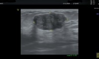 Pat. 23a, verspürte vor 3 Jahren Knoten in der Brust. Diagnose: juvenile Fibroadenomatose, das größte Fibroadenom 28x21mm, groessenkonstant derzeit. Kontrolle vereinbart.