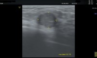 Pat. 40a, spürt Knoten re Brust, nicht klar zuordenbar, entweder Fibroadenom oder proteingefüllte Cyste, kurzfristige Kontrollen vereinbart, seit 1.5 Jahren keine Veränderung.