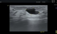 Pat. 51, großcystische Mastopathie beidseits,kein Therapie nötig