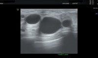Pat. 54a, Zustand nach Brustkrebs-OP 6/19.Farbdopplerbrustultraschall zeigt sich eine großcystische, gutartige Mastopathie.