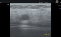 Pat. 80a, ausgeprägte, komplexe cystische Mastopathie