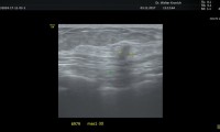 Pat. 65a, beschwerdefrei. Regelmäßige Brustuntrsuchung. 3.11.17: Brustultraschall: nicht unverdächtige Strukturalteration. In der Mammographie keine Auffälligkeiten. Auch in der MRT: kein Anhaltpunkt für Bösartigkeit, aber Verlaufskontrollen.