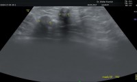 Pat. 50a. 2011 Brustverkleinerungs-OP. Im Ultraschall 2 kleine Läsionen. Narben? ad MG. MG: gutartige verkalkte Cysten
