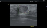 Pat.50a, bekannt großcyst.Mastopathie, nun erneut neue Cyste mit Protein gefüllt.Farbdoppler OB. Vom Radiologen zusätzlich MRT empfohlen.Befund:kein Hinweis auf Bösartigkeit.