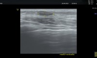 Pat. 45a, seit 11 Jahren bekanntes Fibroadenom