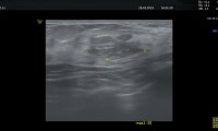 Pat.48a, Zustand nach Hamartomentfernng rechte Mamma 2012, nun seit 2 Jahren bekannte, gutartiger Herdbefund linke Brust