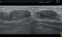 Pat.48a, seit 10 Jahren bekanntes, grosses Fibroadenom, beschwerdefrei