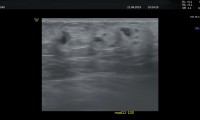 Pat. 52a, st.p.Contusio Mammae Dext nach einem Autounfall, man sieht Hämatom in sogenannter "Organisation" .