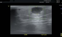 59 jährige Patientin, aus einem Atherom sich entwickelndes Abszeß. Therapie: Inzision