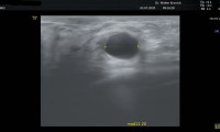 55 jährige Patientin, bekannte 12mm große Cyste