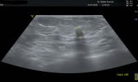 65 jährige Patientin, seit 7 Jahren bekanntes Fibroadenom, gutartig
