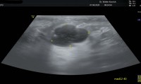 45a Patientin, seit Jahren großcystische Mastopathie, in wechselnder Größe.