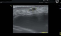 56 jährige Patientin mit Implantaten, vom Aspekt her gutartiges Fibroadenom
