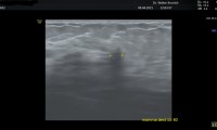 47 jährige Patientin, beschwerdefrei. Mammographie: unauffällig. Mammasonographie:verdächtiger Herdbefund, angedeutet spikuliert, mit Schallauslöschung. MRT: kein Hinweis  auf Bösartigkeit.
