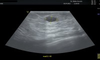 39 jährige beschwerdefreie Patientin. Zufallsbefund: Cyste 14x7mm