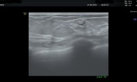 Pat. 65a, seit 6 Jahren gutartiger Lymphknoten schallbar.